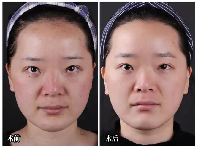 敏感性皮肤改善案例分享