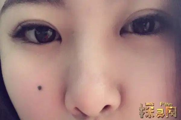 面部痣相分析脸上痣相凶吉解析福祸相依