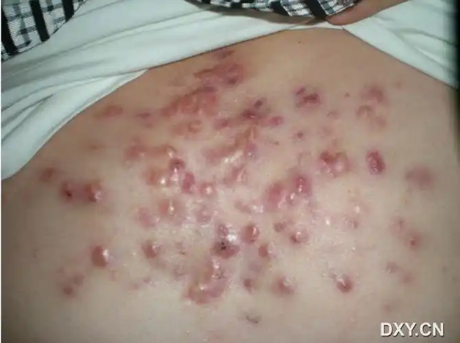 【共享】自己收集的一些临床皮肤病图片-不断更新中