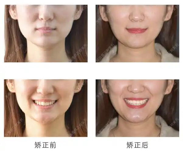天津牙齿矫正│上下颌扩弓 片切恢复正常覆合覆盖关系