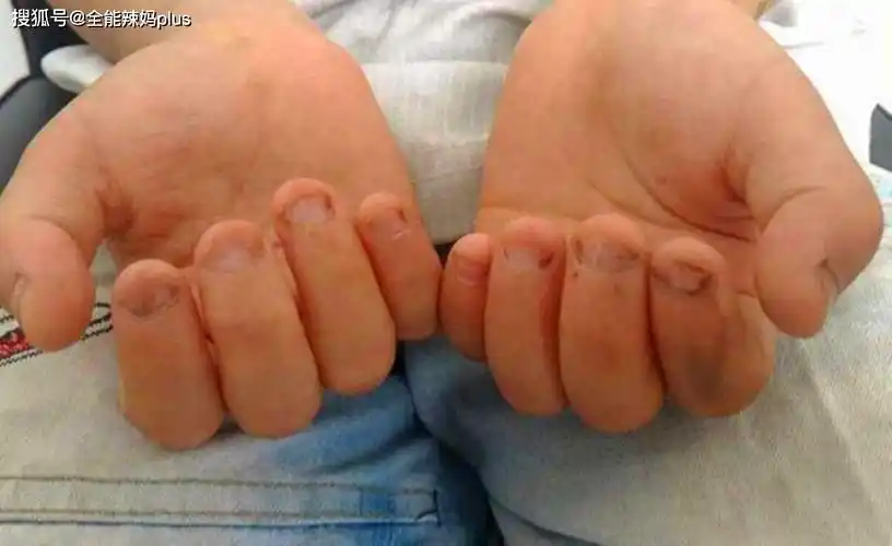 原创从小"啃"指甲的孩子,长大基本逃不出这3种结局,爸妈别不在意