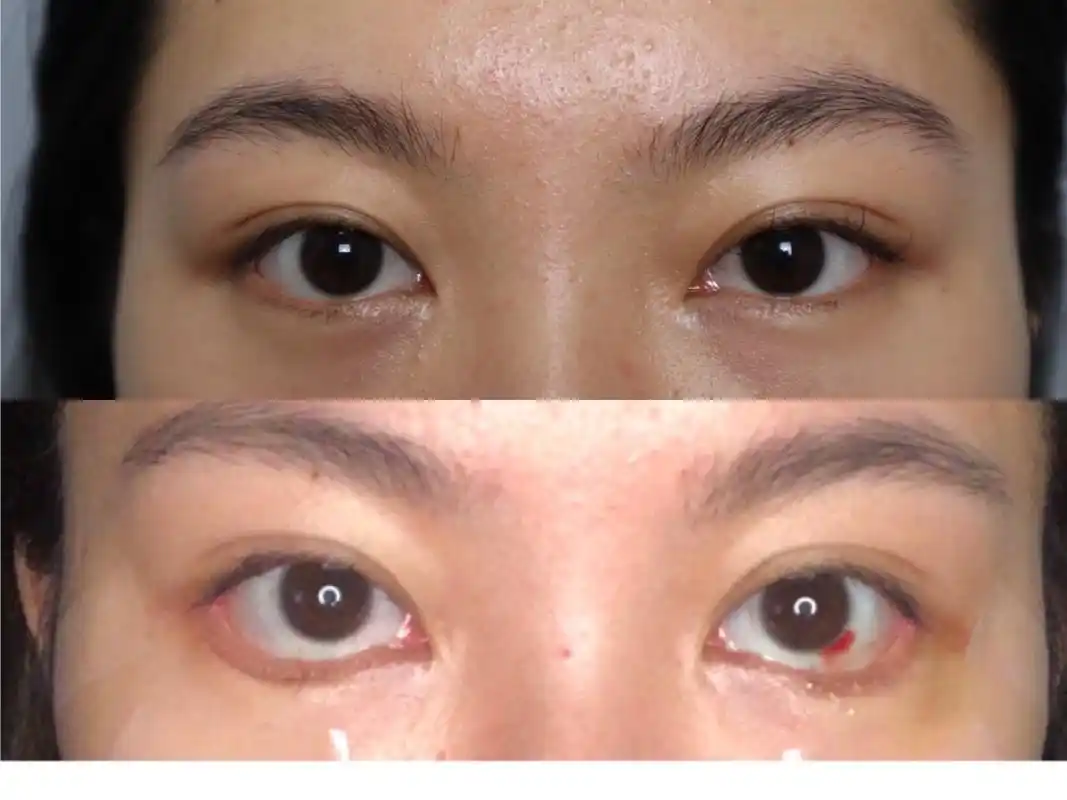 眼睑下至外眼角手术