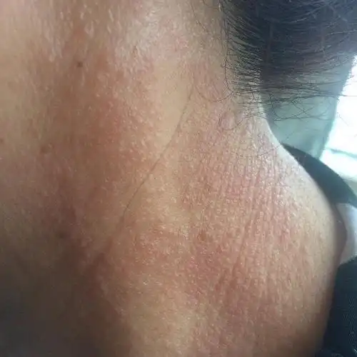 宝宝脖子红疹是衣服刺激引起的吗宝宝脖子全是红疹子