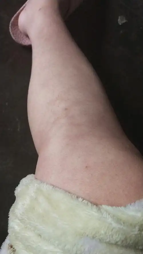 纹,如果是的话以后连短裤都不敢穿了_预产期2019年05月准妈圈 - 妈妈