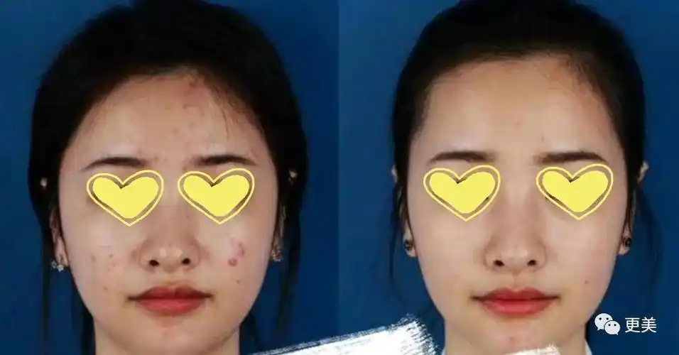 微针对比图 来看一组果酸换肤对比图,祛痘效果还是挺明显的.
