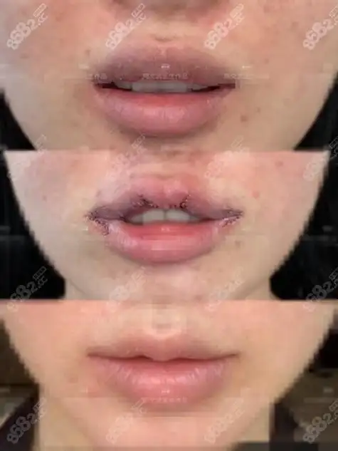 国内厚唇改薄医院医生排行:胡俊杰,周文武都有包含