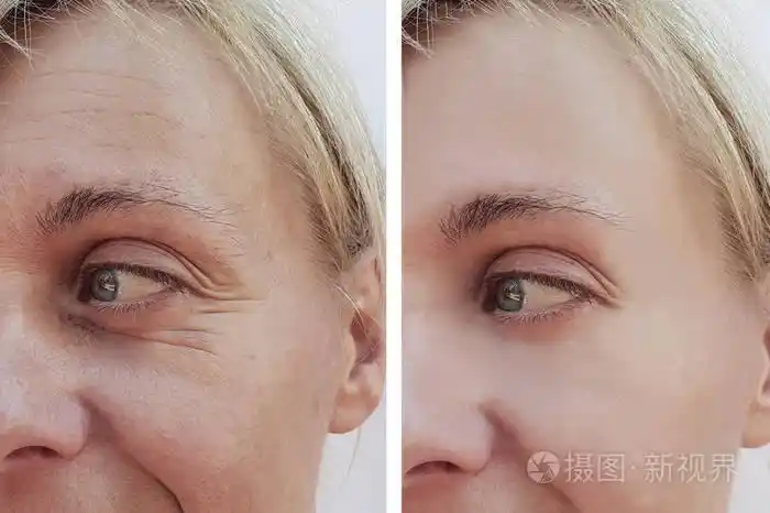 妇女在抗衰老程序前后脸上的皱纹