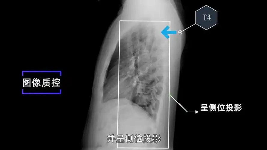 收藏x线摄影技术胸部正侧位摄影标准摆位图文解析