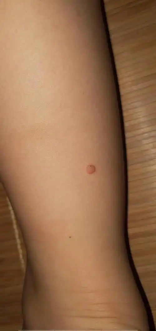 六岁小朋友小腿上长了一个类似肉痣的东西,不痛不痒,但感觉逐渐变大