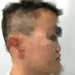 binder综合征是颅颌面外科的常见疾病,其发病机理目前还不是十分清楚.