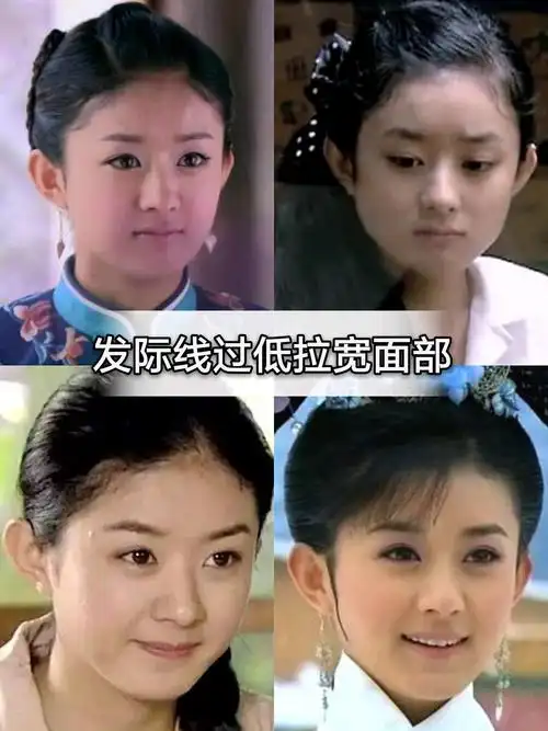 96早期的赵丽颖和黎姿毛发较旺盛,导致了发际线的形状_圈子-新氧