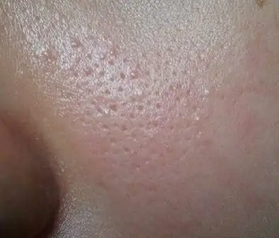 毛孔粗大堵塞使用洗脸神器好吗