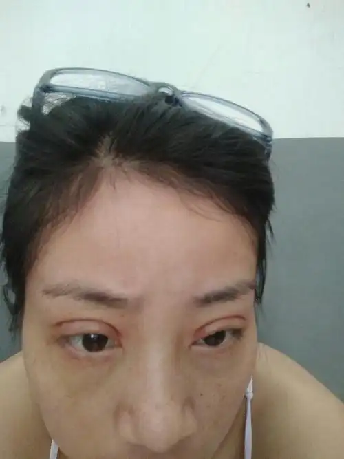 割双眼皮10mm太宽了能不能恢复好呀,心塞第二张是没做之前的