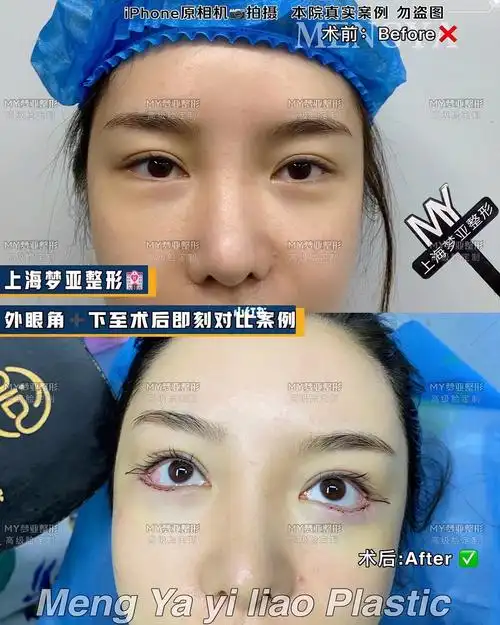 外眼角77下至术后即刻对比案例