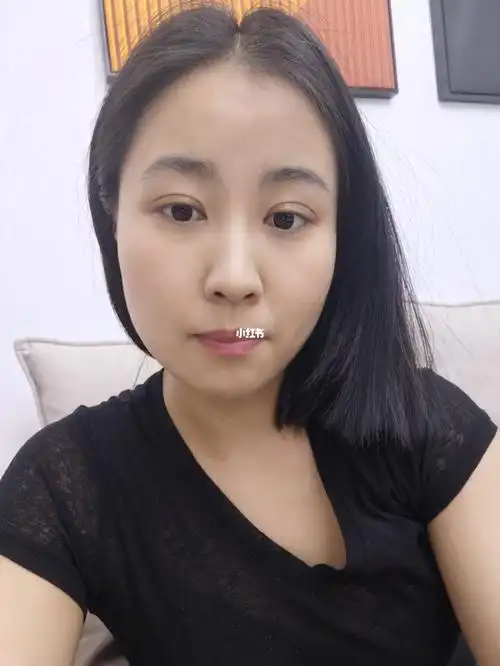 埋线双眼皮第二十七天