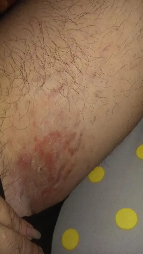 个月爆肥的生长纹,到后来感觉越来越不对了,颜色比较深的地方皮肤褶皱