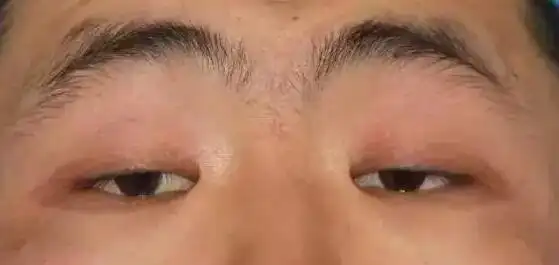其实眼皮下垂是种病 不好看的同时还会