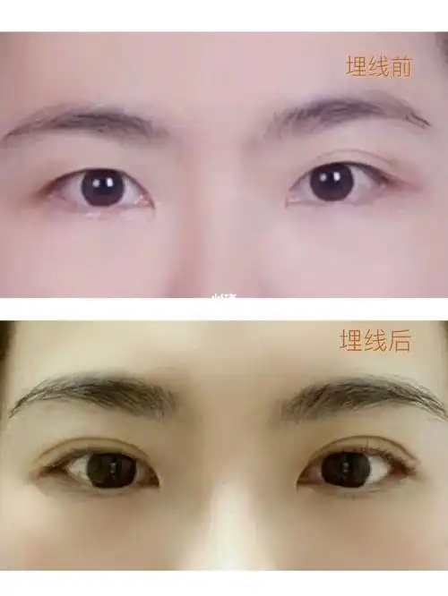 埋线双眼皮
