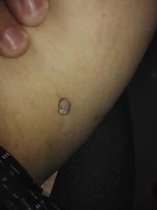 大腿内侧长一个肉疙瘩不知道是什么一年多了吧不疼不痒没