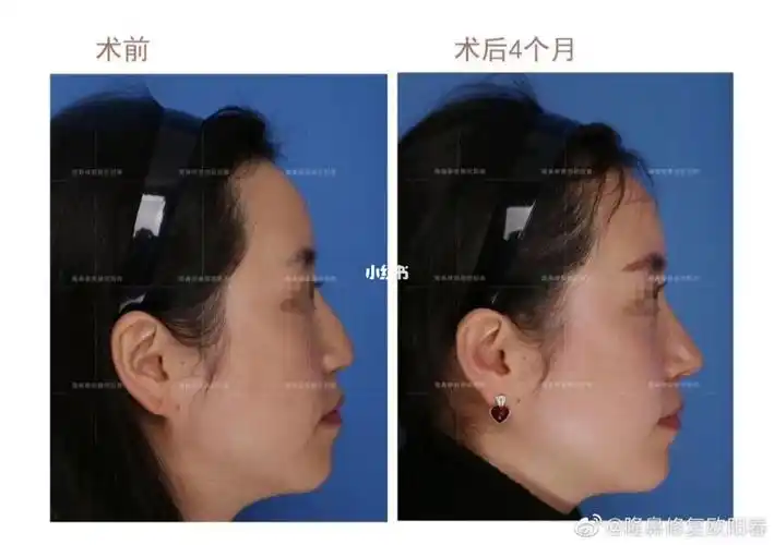 【驼峰鼻矫正61术后四个月对比反馈】_驼峰怎么样_鼻综合_支架_驼峰
