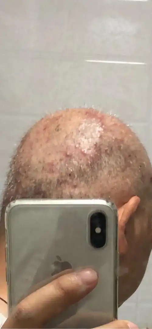 请教二疗后头皮上长红疙瘩