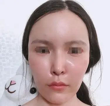 全脸脂肪填充有人后悔吗?业内人士劝你填充前慎重考虑!