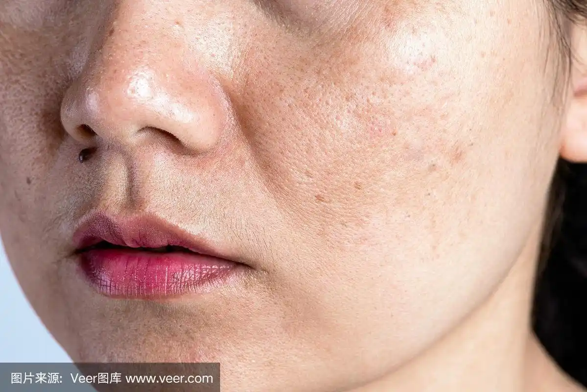 皱纹,黄褐斑,黑斑,雀斑,皮肤干燥,色素沉着,亚洲女性.