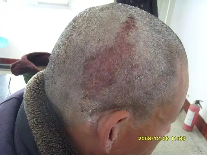 头部湿疹