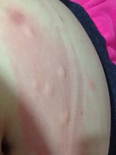 肚子上和手脚长了好几颗像蚊子咬的大包!肚子上本来只有三个!