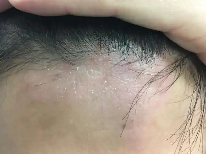 皮肤病的诊断和鉴别诊断也是很复杂的一个病在治疗了