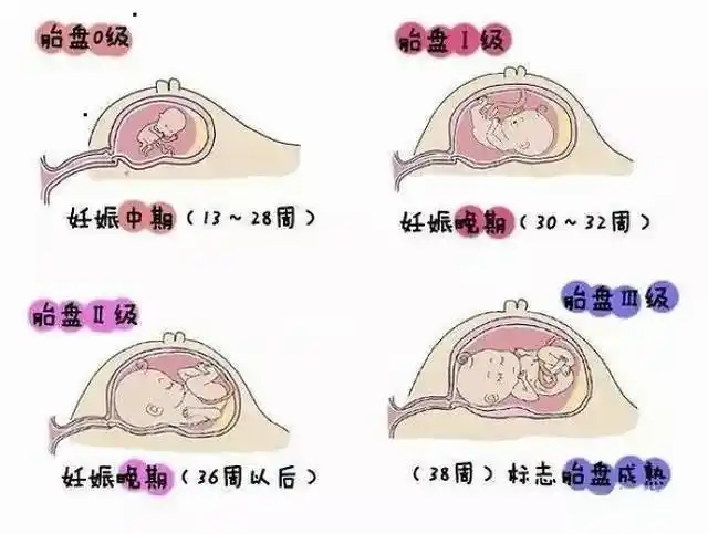 到三个月基本形成,这是胎盘的0级状态,胎盘绒毛就像一条发光的线,但