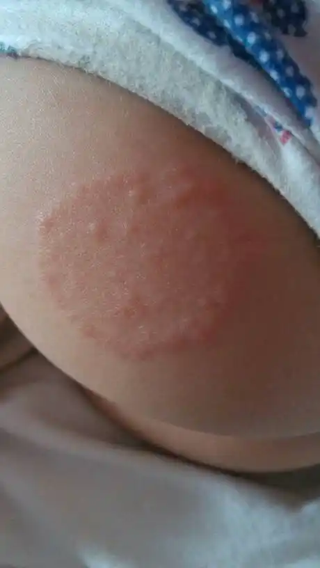 宝宝11个月大,屁股上长了一块东西,那块上面都是红红的小疙瘩状,会痒