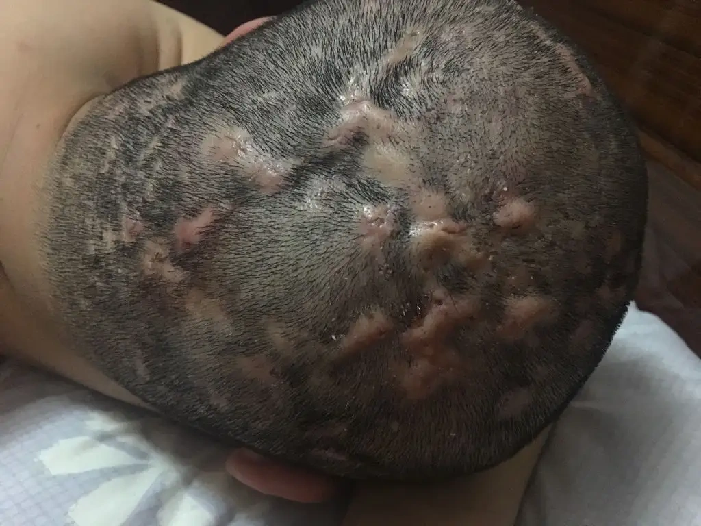 头皮上长疙瘩和脓包,是怎么回事?忠告:或与3种问题有关