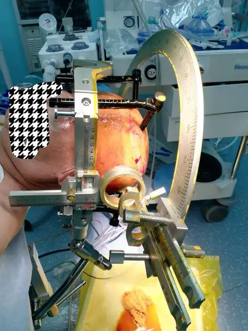 [剖头颅,除积血]龙湾院区神经外科首例利用立体定向技术治疗脑出血