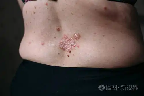 湿疹过敏性皮炎症状皮肤纹理 clouseup 照片