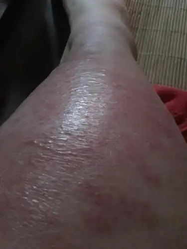 吹空调脚冻伤像灼伤