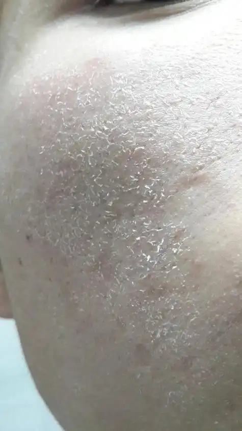 脸上干燥脱皮:最常见的是嘴角脱皮