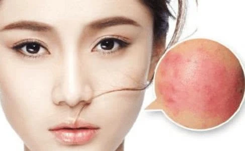 皮肤发红干痒,红血丝敏感肌肤如何做好日常护理?__凤凰网