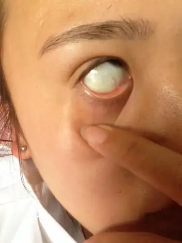 眼睛现在红血丝特别多.寒假连带半个月的美瞳没点事.后来过了一个月.