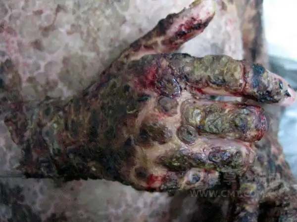 大疱表皮松解败血症患者获救