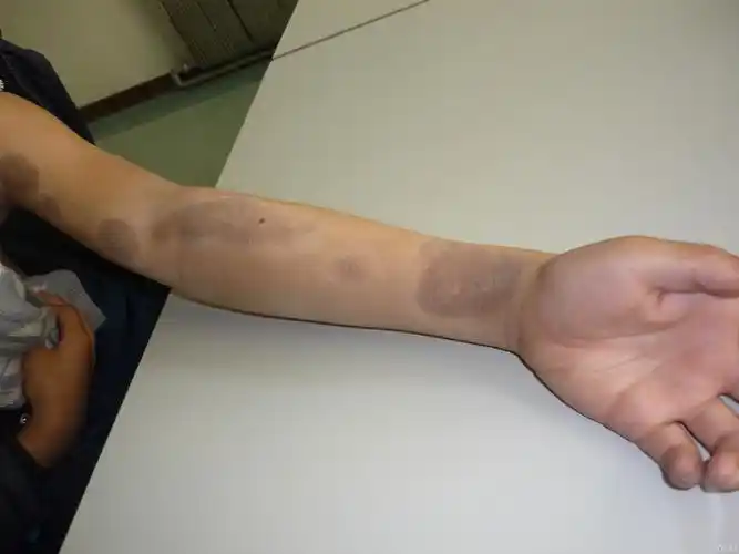 左上肢黑褐色斑 - 皮肤及性传播疾病讨论版 - 爱爱医医学论坛