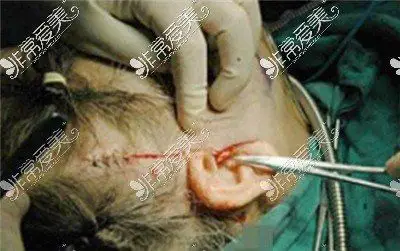 拉皮手术实拍