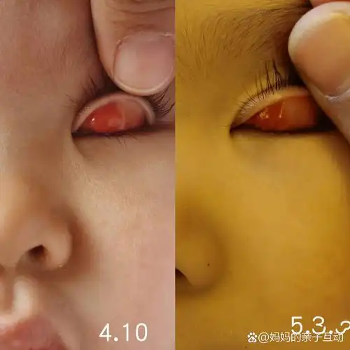 一岁三个月 霰粒肿睑板炎囊肿 治疗中(二) 4月16日 去朋友介绍的地方