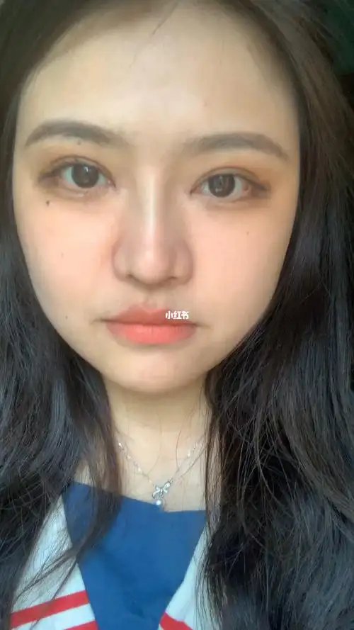 第28天包眼角修复双眼皮