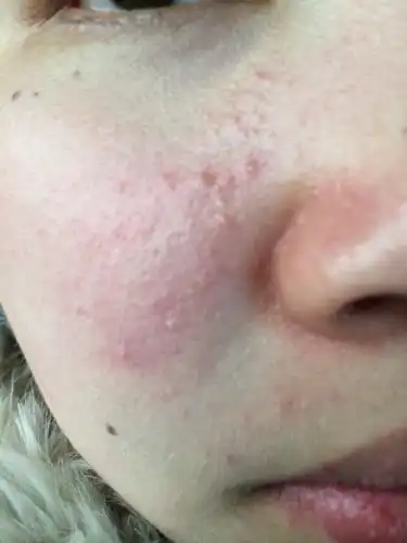 脸上长痘痘五年,用过很多药一直不好,皮肤严重受损,高敏感,,怎么办?