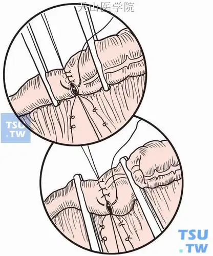 回结肠端端吻合