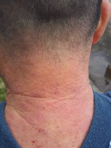 临床第三区 69 皮肤及性传播疾病讨论版 69 全身皮肤皮疹伴瘙痒