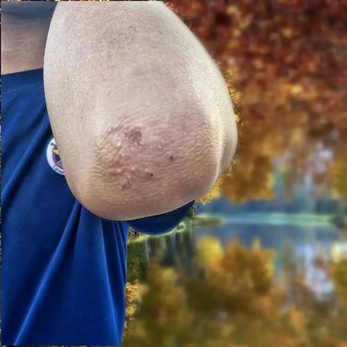 推荐胳膊肘长藓瘙痒胳膊肘神经性皮炎胳膊肘长湿疹疙瘩牛皮癣银屑