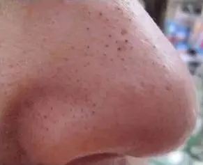 毛孔粗大有黑头咋办