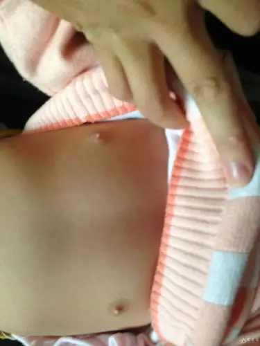 求助10个月女宝宝较白较突起